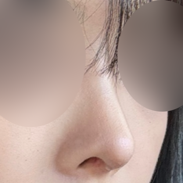 수술 전 후