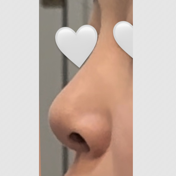 수술 전 후