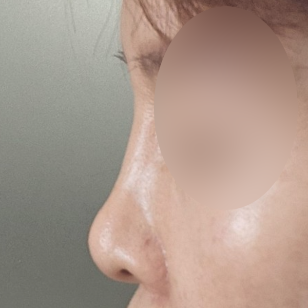 수술 전 후