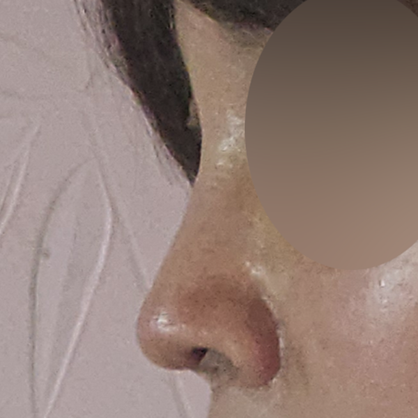수술 전 후
