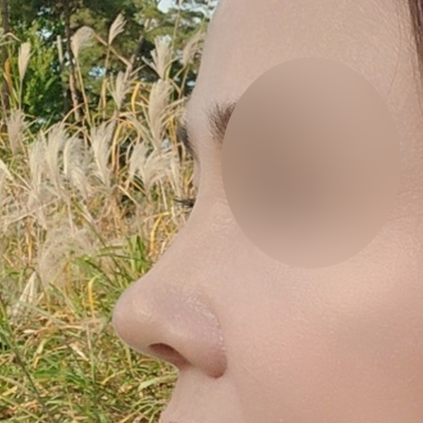 수술 전 후