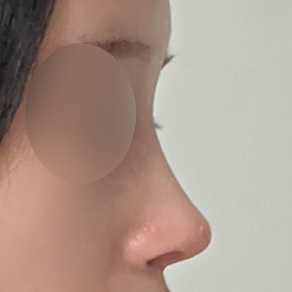 수술 전 후