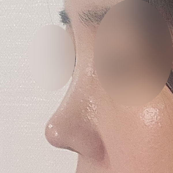 수술 전 후