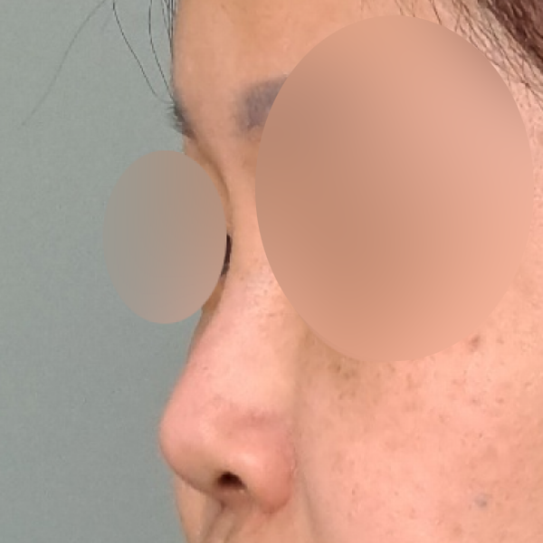 수술 전 후