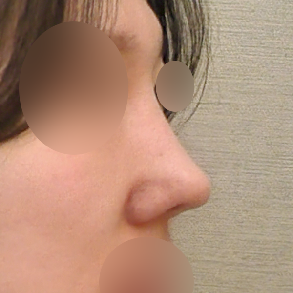 수술 전 후