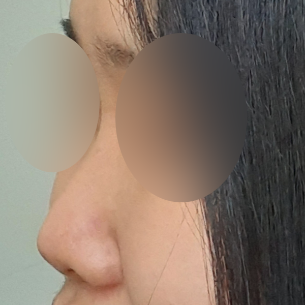 수술 전 후